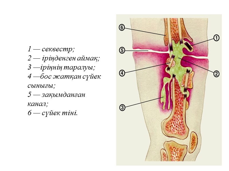 1 — секвестр;  2 — іріңденген аймақ;  3 —іріңнің таралуы;  4